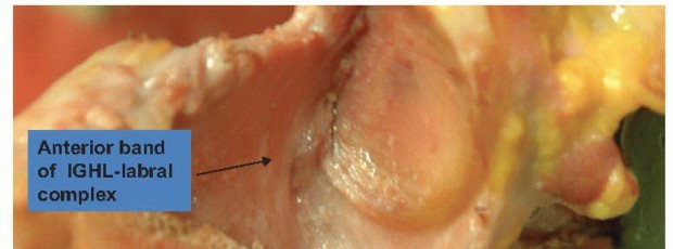 Regain Stability: Arthroscopy for Anterior Instability & the Inferior Glenohumeral Ligament