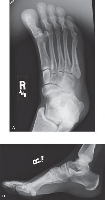 Illustration of fifth metatarsal fractures - Dr. Mohammed Hutaif