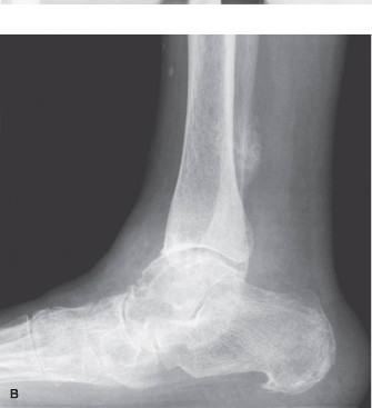 Illustration 4 for Foot & Ankle Pain: When radiographs are obtained, what do they reveal?
