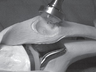 Illustration 9 for Solving Severe Bone Loss: Tantalum for Patellar Reconstruction