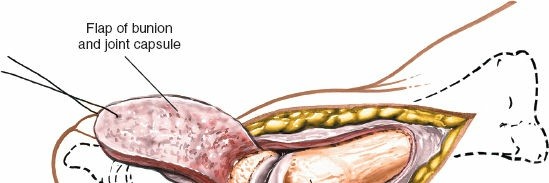 Illustration 203 for Optimized Approaches to the Dorsum of the Foot & Ankle