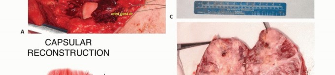 Illustration 19 for Complex Popliteal Resections: Protecting the Greater Saphenous Vein