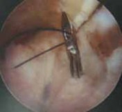 Illustration 34 for Resolving Femoral Head Neck Impingement: Arthroscopic FAI Solutions