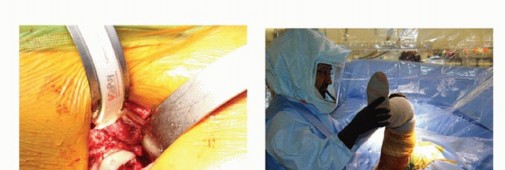 Illustration 23 for Anterior FAI Relief: Mini-Open Anterior Approach Explained