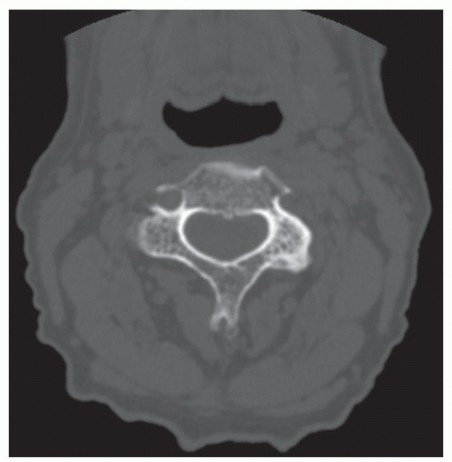 Achieve Stability: Posterior Cervical Lateral Mass Screw Fusion