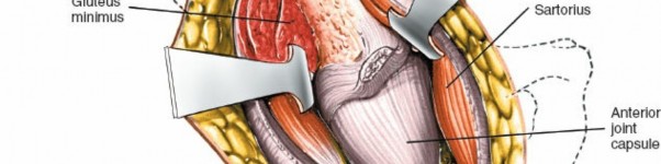 Illustration 48 for Unlocking Every Aspect of the Hip's Surgical Approaches