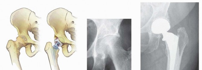 Illustration 8 for Regain Mobility: Total Hip Arthroplasty for Malignant Lesions