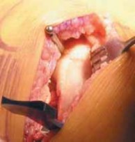 Illustration 14 for Knee Arthroplasty Unicondylar: Discover if Partial Knee Replacement is Right