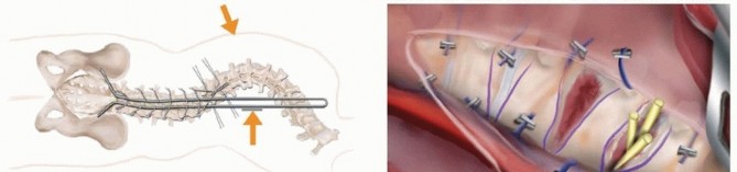 Illustration 8 for Duchenne Muscular Dystrophy: Is Spinal Fusion the Answer?
