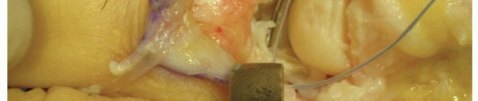 Illustration 21 for Plantar Plate Repair: End Lesser Toe Pain & Instability