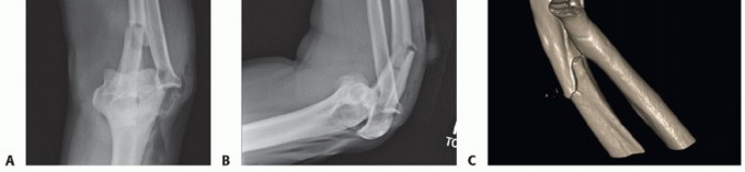 Illustration 10 for Radial Head & Neck Fractures: Mastering ORIF for Best Results