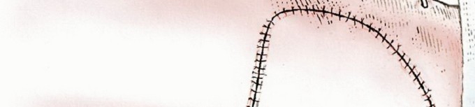 Illustration 19 for Beyond Hemipelvectomy: Preservation of the Sciatic in Buttock Surgery