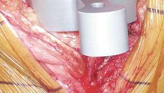 Illustration 44 for Mastering Valgus Total Knee Replacement: Techniques & Pitfalls