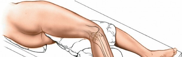 Illustration of approach to the tibia - Dr. Mohammed Hutaif