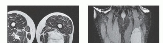 Illustration 4 for Posterior Thigh Resection: Rethinking Outcomes & Limb Sparing