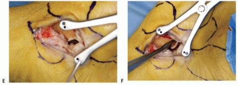 Illustration 59 for Medial Ankle Instability: Find Relief with Reconstruction