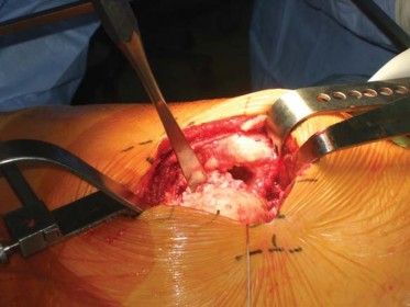 Illustration 80 for Successful Total Hip Replacement in Developmental Dysplasia