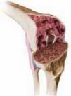 Revision Arthroplasty with Femoral Bone Loss: Metal Augments
