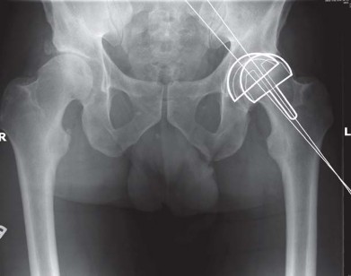 Illustration 86 for Metal on Metal Resurfacing: Enhanced Posterior Soft Tissue Repair