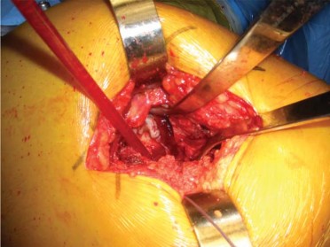 Illustration 83 for Successful Total Hip Replacement in Developmental Dysplasia