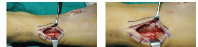 Illustration 44 for Restore Movement: Tendon Transfer for Common Peroneal Nerve Foot Drop