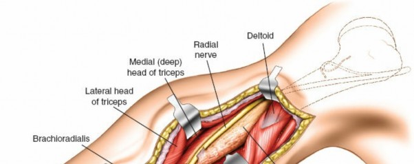 Illustration 69 for Mastering the Approach to the Distal Humerus: Safety & Skills