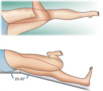 Illustration 15 for Mastering the Anterolateral Approach in Minimally Invasive Hip Replacement