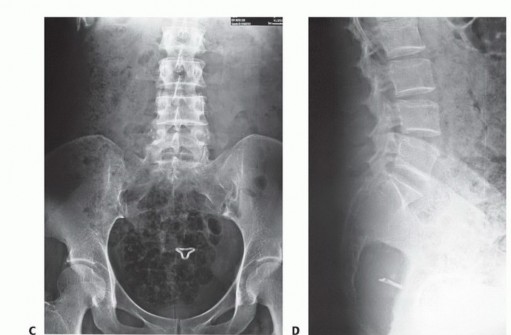 Illustration 16 for Sacral Tumor Surgery: Safeguarding Bowel & Bladder Control