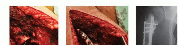 Illustration 29 for Restore Vital Function: Surgery for Type II Humeral Metastasis