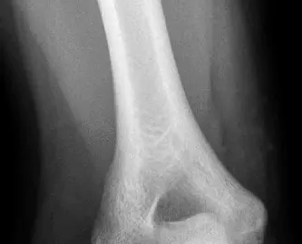 صورة توضيحية لـ آلام المرفق المعقدة: فهم وعلاج وتر الكاربوس الزندي القصير وغيرها من إصابات المرفق مع الأستاذ الدكتور محمد هطيف