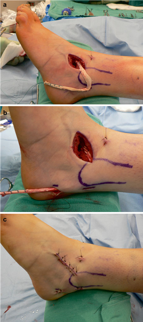 Illustration 27 for First Metatarsal Surgery: Expert Solutions for Foot & Ankle Pain