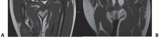 Illustration 9 for Treatment for Congenital Femoral Deficiency: What You Need to Know