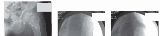 Illustration 10 for ORIF for Peritrochanteric Hip Fractures: Achieve Stable Mobility