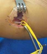 Fascia Lengthening Gastrocnemius: Relieving Equinus