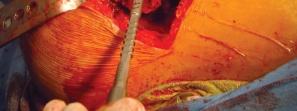 Illustration 39 for The Silent Hip: Achieving a Truly Silent, Pain-Free Joint