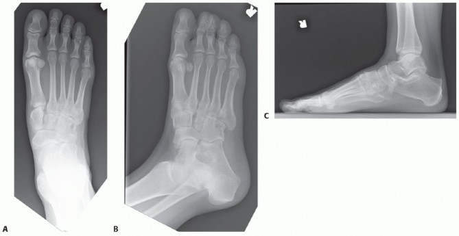 Mastering Midfoot Arthrodesis: Protect the Deep Neurovascular Bundle