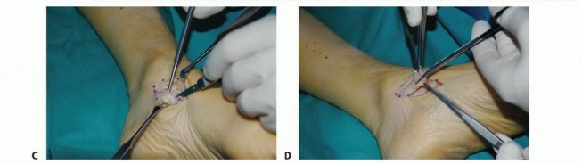 Illustration 25 for Foot Drop Surgery: How a Pin or Drill Elevates Tendon Transfer