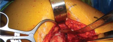 Illustration 85 for Successful Total Hip Replacement in Developmental Dysplasia