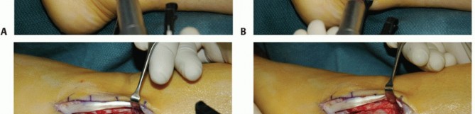 Illustration 20 for Beyond Primary Repair: Solutions for Peroneal Tendon Subluxation