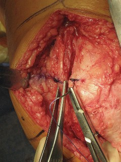 Illustration 54 for Posterior Stabilized Technique: Essential Insights for TKA Success