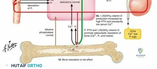Illustration of nutritional rickets nutritional - Dr. Mohammed Hutaif