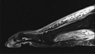 Illustration 2 for Foot Ulcer Diagnosis: Is It Isolated Gastrocnemius Contracture?