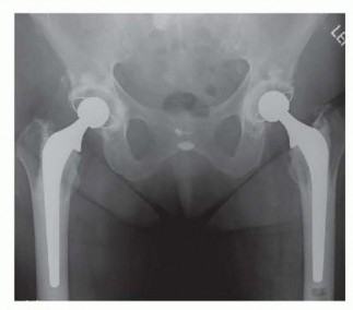 Illustration 20 for Cemented Total Hip: A Successful & Evidence-Based Solution