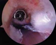 Illustration 16 for Successful Ligament Repair Revision: Fixing Failed ACLs
