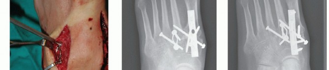 Illustration 74 for Mastering Midfoot Arthrodesis: Protect the Deep Neurovascular Bundle