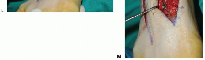 Illustration 34 for Mastering Midfoot Arthrodesis: Protect the Deep Neurovascular Bundle