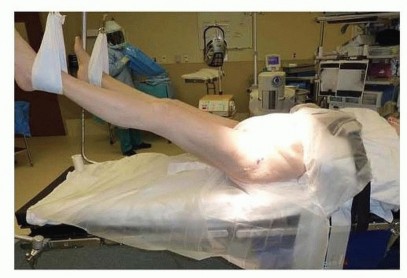 Illustration 3 for Hemiarthroplasty of the Hip: Indications & Types Explained