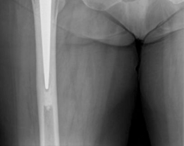 Illustration 8 for Analyzing a Hybrid Primary Hip Arthroplasty Patient Case