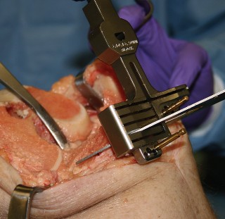 Illustration 6 for Understand Augments: The Role of Metal Augments in Arthroplasty