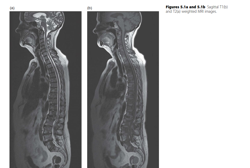 Illustration 2 for Essential Questions: Spinal Tumour Diagnosis & Treatment